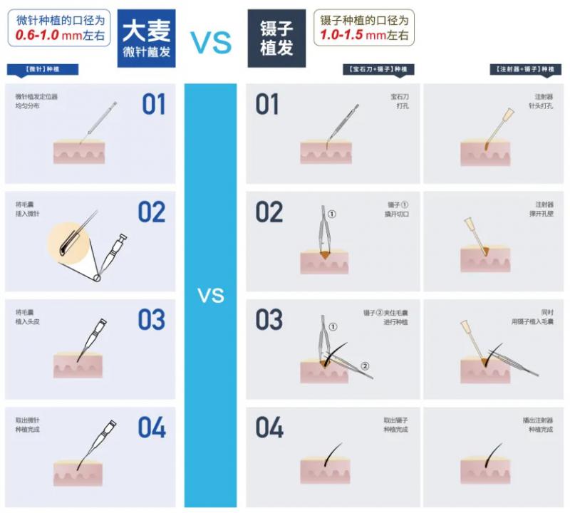 植发后已经过了脱落期，怎么头发还是不长？