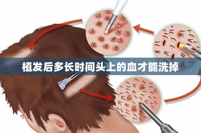 植发后多长时间头上的血才能洗掉