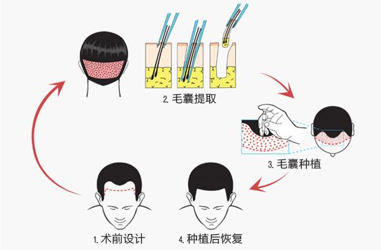 植发的效果能保持多久？