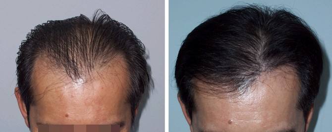 植发加密手术会不会影响原生发呢？影响植发效果的原因？