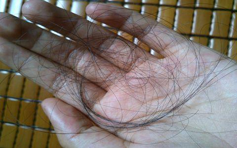 天生头发少植发有用吗？溢脂性脱发植发有用吗？