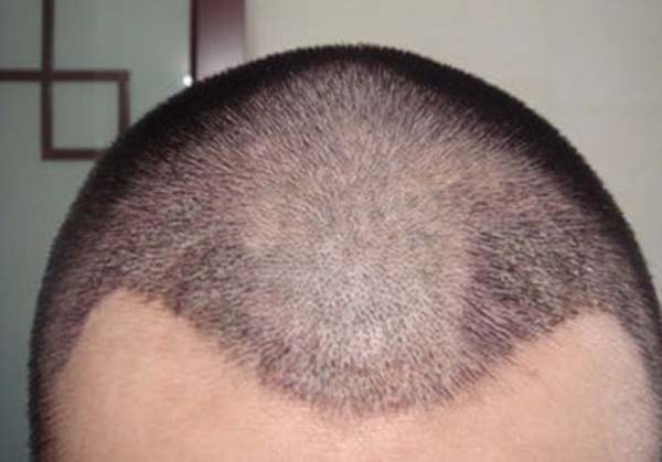 脱发植发有没有伤害？伤害身体吗植发？