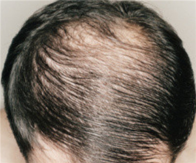 雄激素性脱发有哪些早期症状