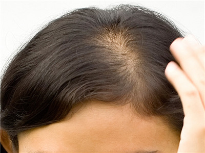 脱发可能是是什么病症的迹象呢