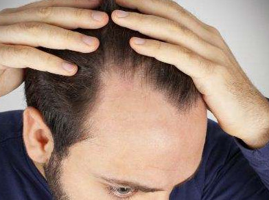 男性在脱发早期有哪些症状？