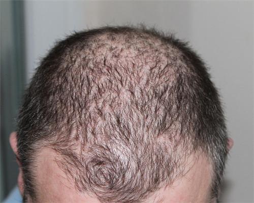 脂溢性皮炎会导致脱发吗