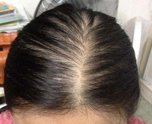 女性脂溢性脱发怎么办 脂溢性脱发吃什么药长头发