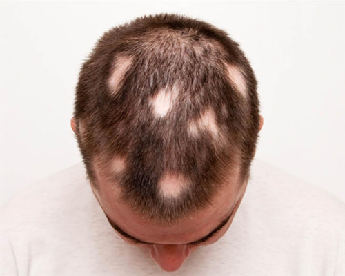 脱发是由单个因素导致的吗