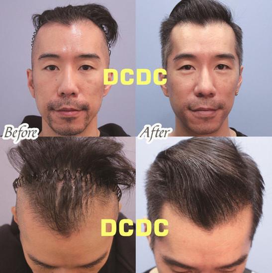 男性秃顶怎么办？什么方法能有效治疗秃顶？