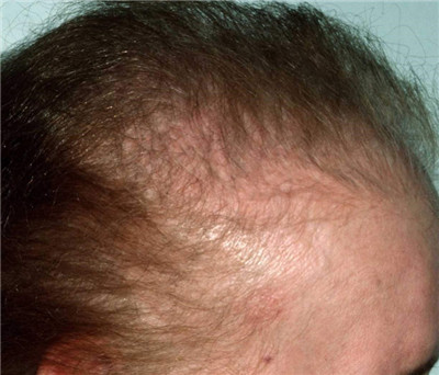 弥漫性脱发的症状是什么