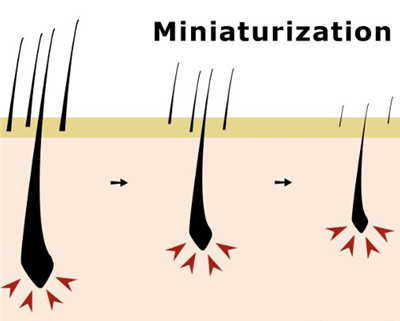 毛囊微型化是什么