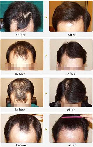 头发稀少如何治疗呢？