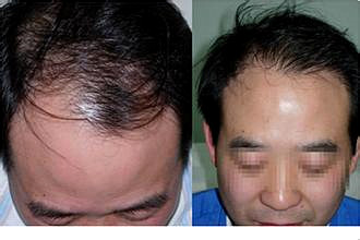 杭州更好的植发医院FUE植发手术多少钱