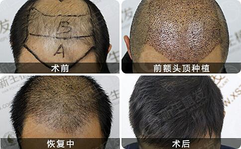 在杭州怎样能预防脱发