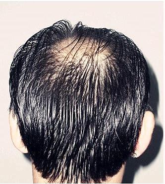 脂溢性脱发是什么原因造成的？
