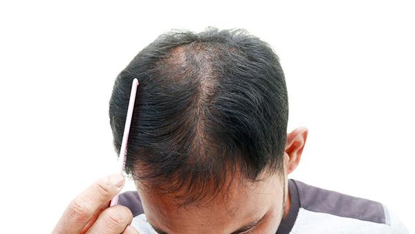 脂溢性脱发如何生发 脂溢性脱发最佳治疗方案