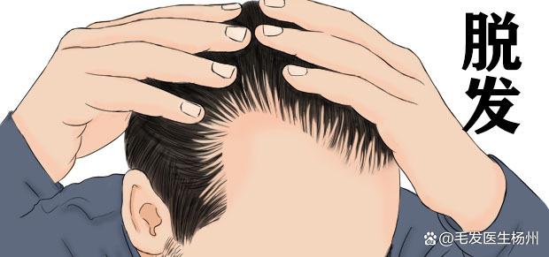 遗传性脱发可怕到不可治愈吗？