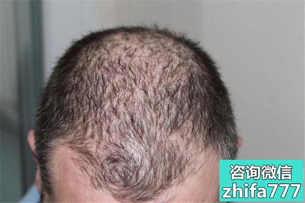 男性经常掉发很有可能是哪些疾病引起的？
