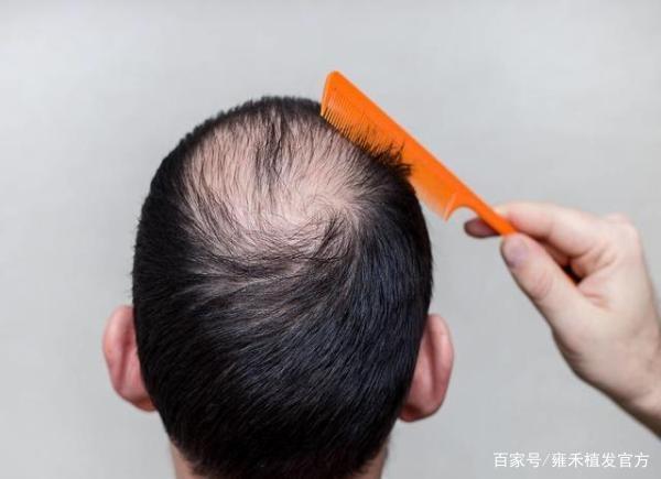 为何秃顶是男人的“专利”？