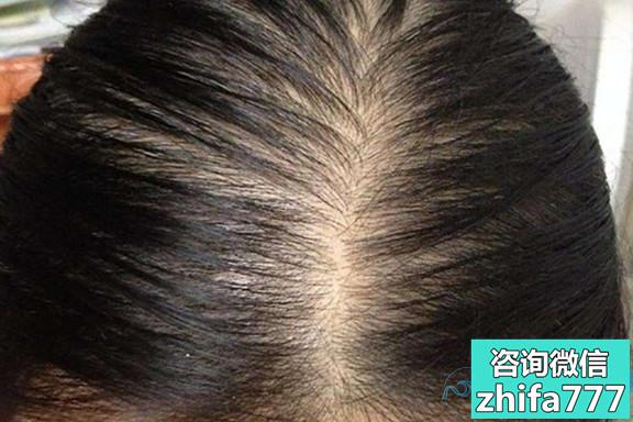溢脂性脱发如何治疗才不会形成持久性脱发？