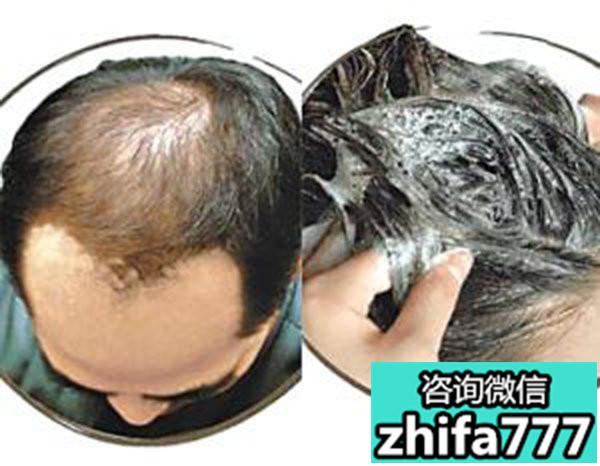 为什么男性比女性更容易掉头发？中国男性脱发比例为什么这么高？