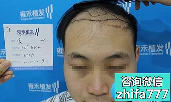别拦我 我就要看重庆雍禾的植发价格和代峰医生的案例图片