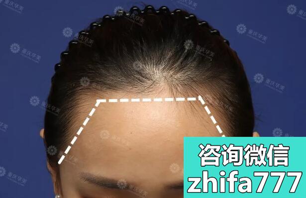 选择在重庆华美植发际线，是因为看到某明星的植发案例
