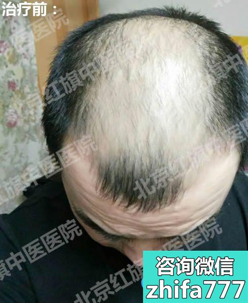 脂溢性脱发怎么办？看我在北京红旗医院治疗脱发的30天效果