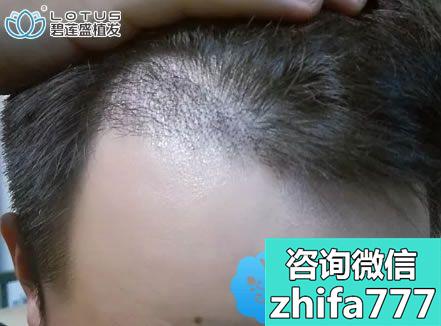 是时候展示我在上海碧莲盛做不剃头植发际线的真正效果啦