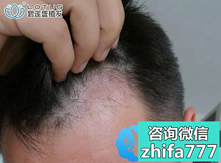 是时候展示我在上海碧莲盛做不剃头植发际线的真正效果啦