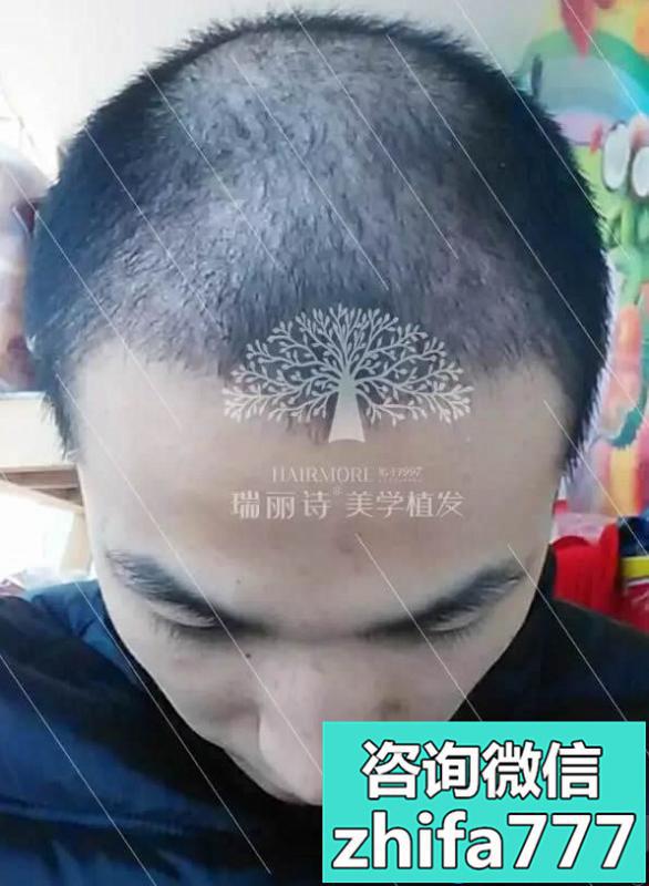 比较了杭州多家植发医院后3。6万做了植发