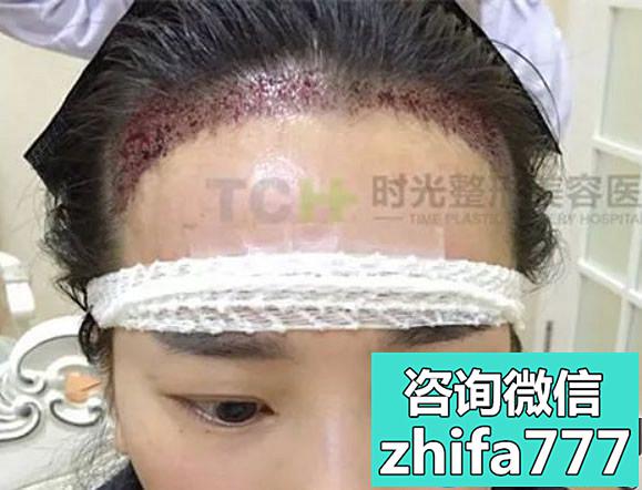 看看重庆时光毛发移植医生杨杰给女士种植发际线的效果图