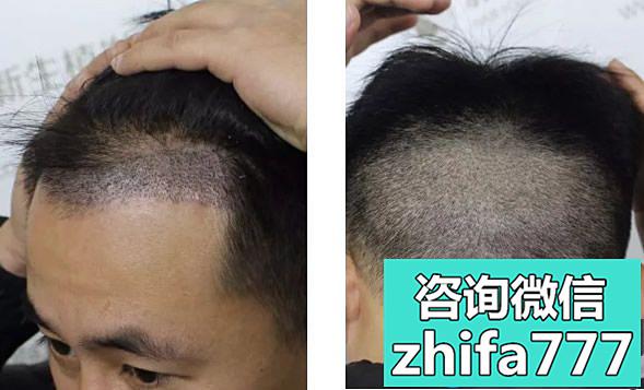我在杭州新生种植发际线已经六个月了 恢复的效果帅呆了