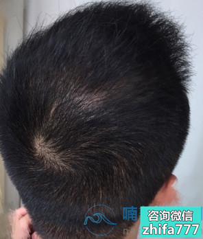 北京新生稀少加密种植，头发非常稳固