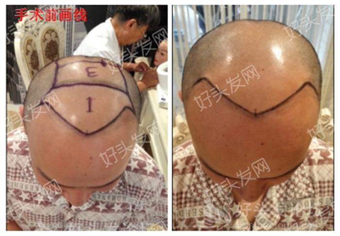 遗传性雄脱如何治疗5级脱发患者的真实写照！