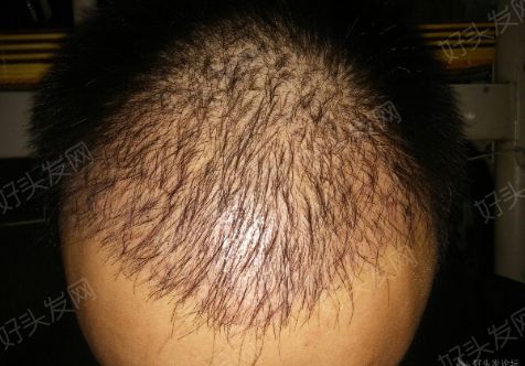 成都科发源植发是治疗脱发的良方