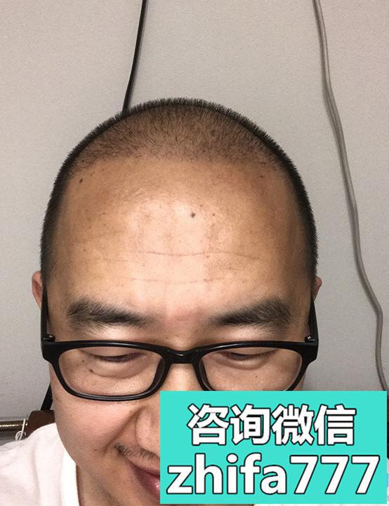 杭州天大秃顶植发案例分享