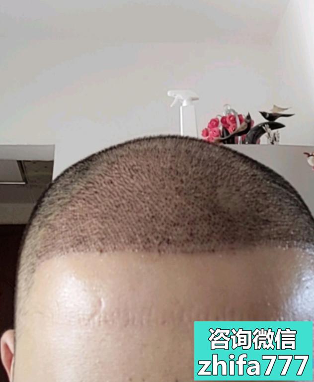 南京植发发际线种植，术后效果显脸小了