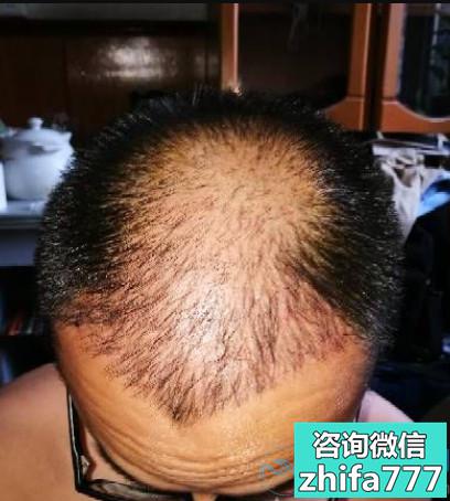 北京南加秃顶植发案例分享