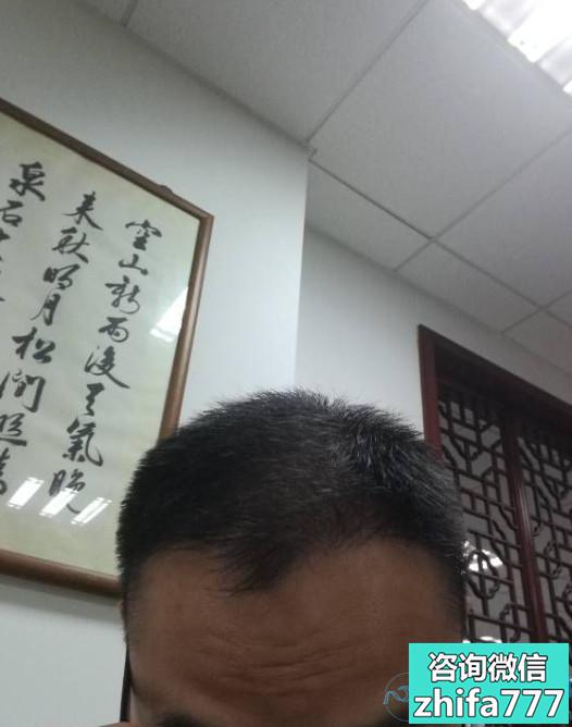 北京南加秃顶植发案例分享