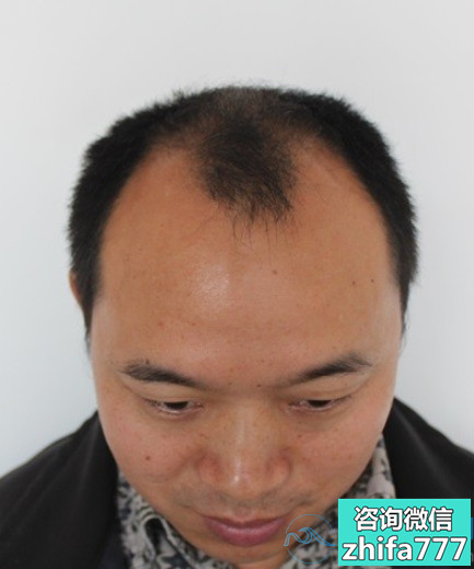 上海新生秃顶植发一年的最终效果