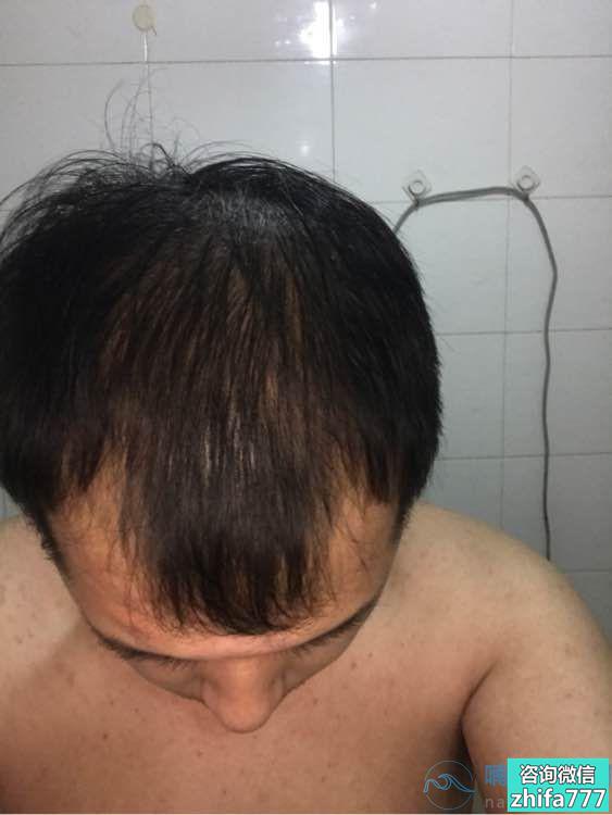 哈尔滨博士园头顶加密植发术后分享