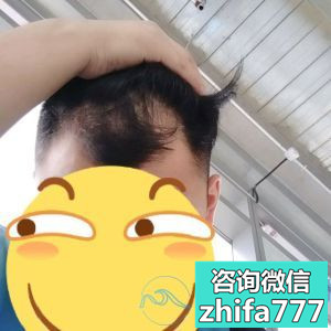 南京艺星发际线种植头发长得很快