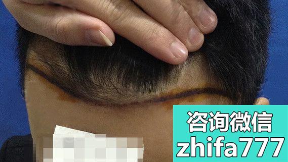 展示下广州肤康植发科做m型发际线种植1000单位的图片效果