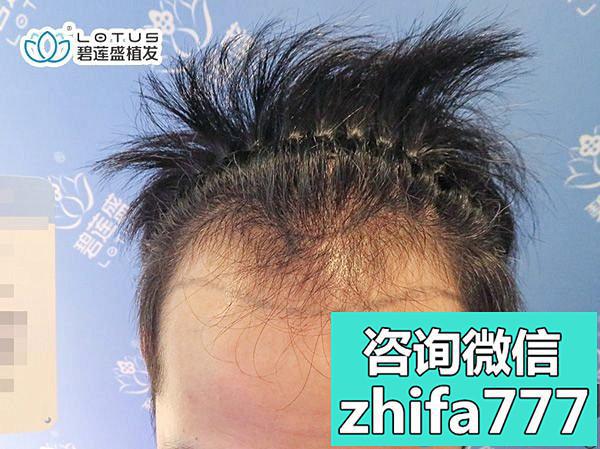 天生额头两边没头发可以用bht植发技术让发际线恢复正常哦！