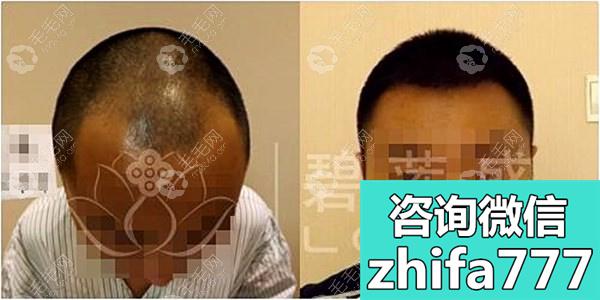 想改变下发型就去广州碧莲盛植m型发际线了，哎呦，效果不错