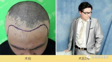 头上疤痕植发案例男士疤痕种植效果