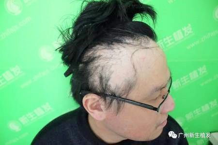 广州植发头部疤痕处不长头发怎么办