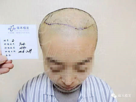 头顶疤痕植发2726单位1年疤痕没了人美了