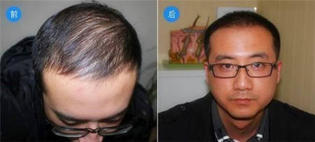 北京头发稀疏加密植发两年后帅气逼人